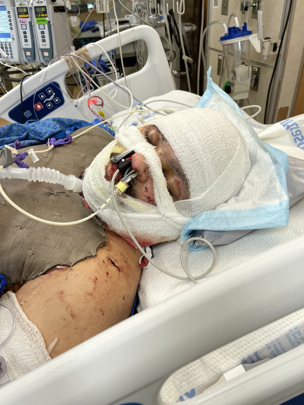 Corey Halstead receiving intensive burn care during the early stages of recovery